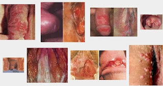 Obat Bintik Bintik Kecil Di Daerah Penis Obat Bintik Bintik Kecil Di Daerah Penis
