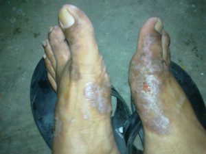 Perawatan Dan Obat Penyakit Kulit Gatal Eksim Paling Ampuh Perawatan Dan Obat Penyakit Kulit Gatal Eksim Paling Ampuh